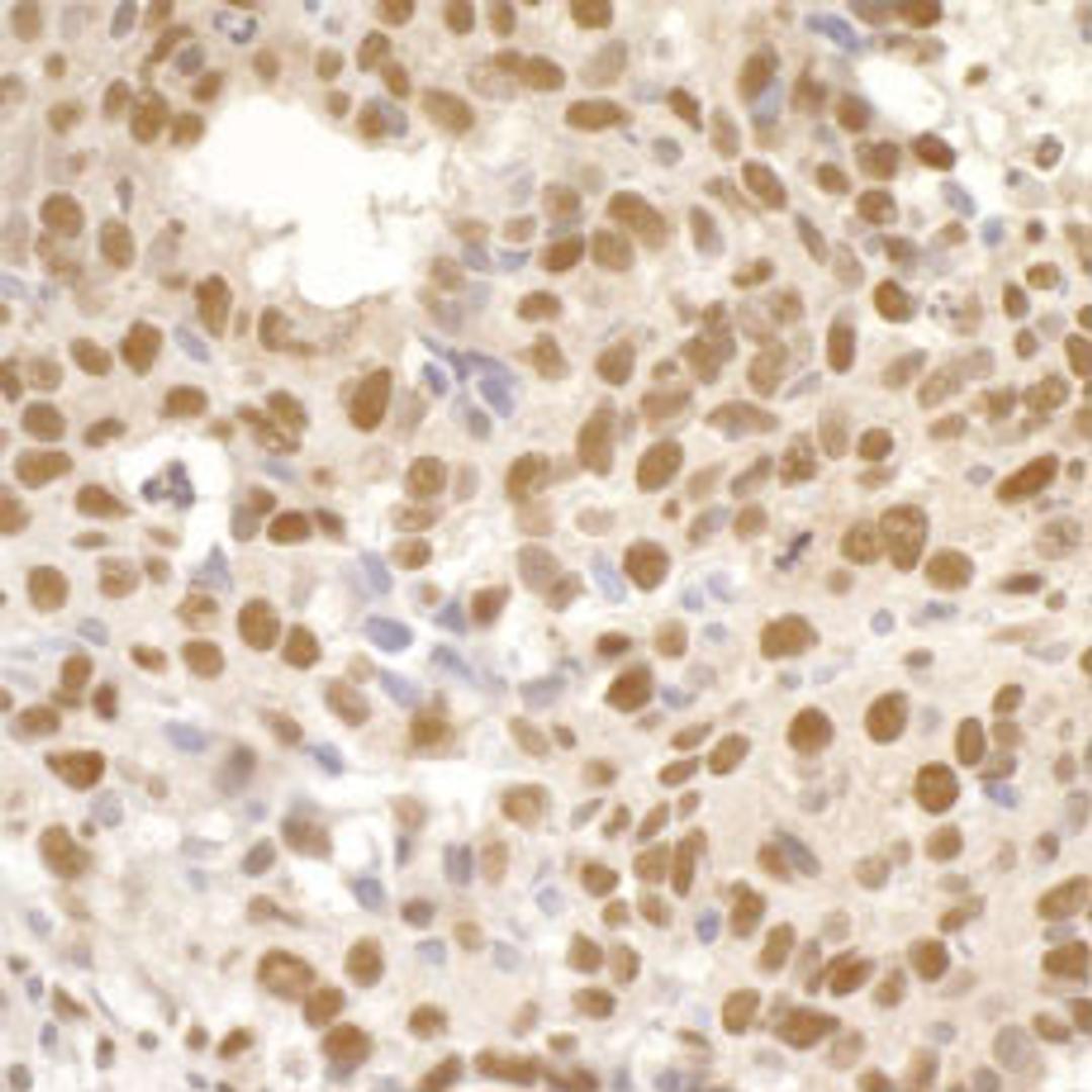 Detection of human Timeless by immunohistochemistry.