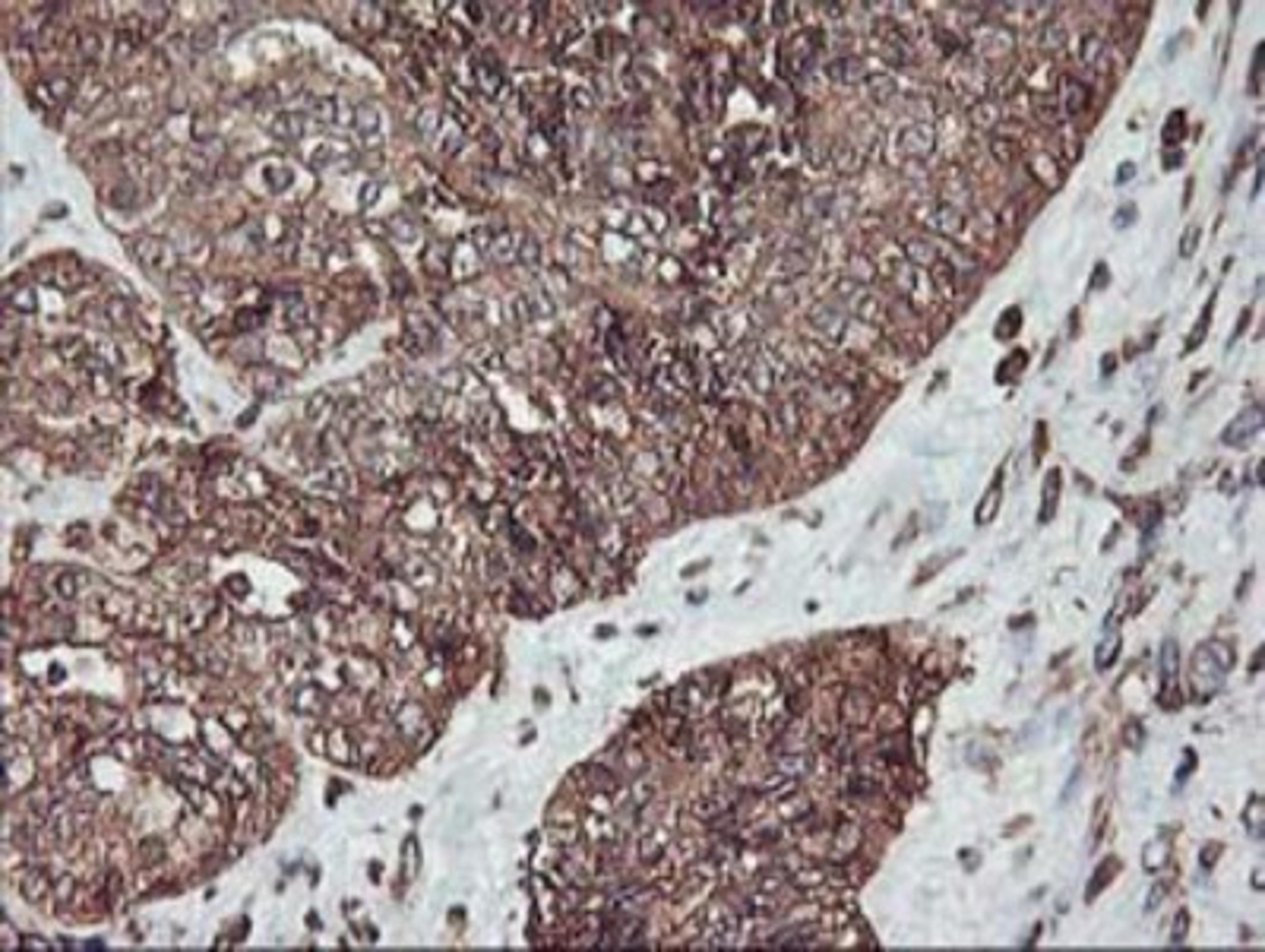 Immunohistochemistry-Paraffin: KvBeta1.1 Antibody (4E7) [NBP2-01526] - Staining of paraffin-embedded Adenocarcinoma of Human ovary tissue using anti-KvBeta1.1 mouse monoclonal antibody.