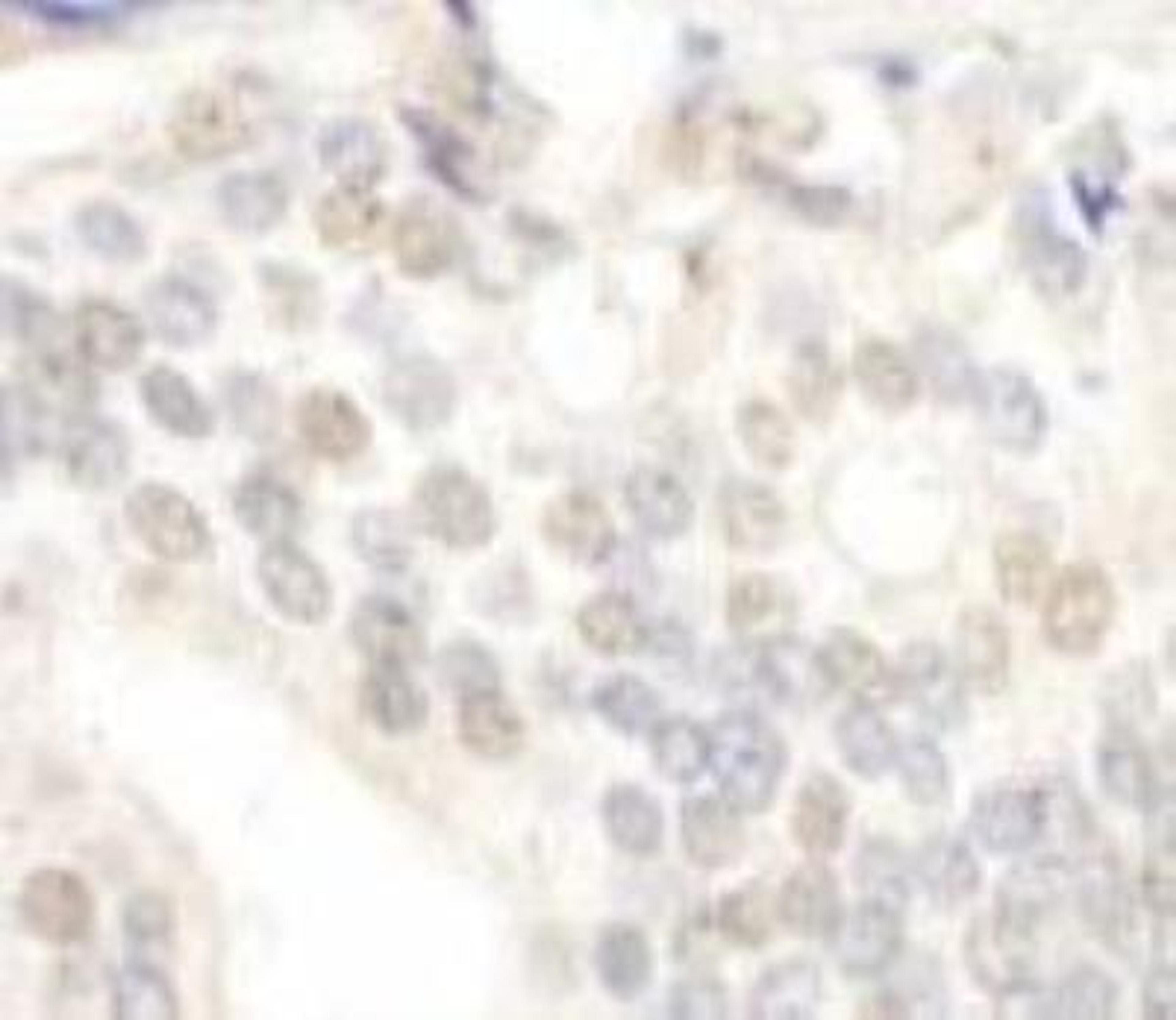 Immunohistochemistry-Paraffin: E2F-4 Antibody [NBP1-21374] - FFPE section of human prostate carcinoma.  Affinity purified rabbit anti-E2F4 used at a dilution of 1:250.