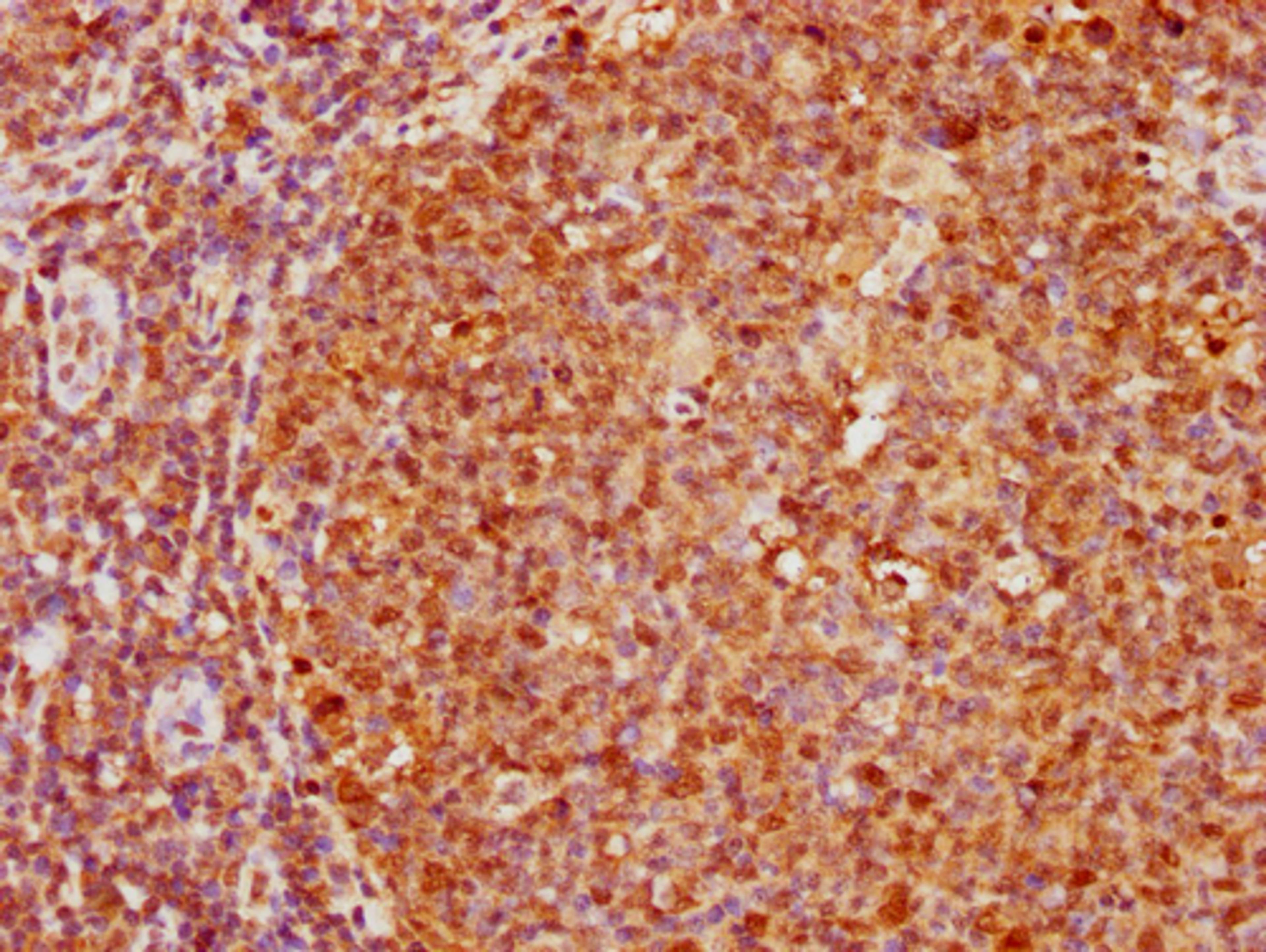 IHC image of CSB-PA010377OA172nphHU diluted at 1:20 and staining in paraffin-embedded human tonsil tissue performed on a Leica BondTM system. After dewaxing and hydration, antigen retrieval was mediated by high pressure in a citrate buffer (pH 6.0). Section was blocked with 10% normal goat serum 30min at RT. Then primary antibody (1% BSA) was incubated at 4°C overnight. The primary is detected by a biotinylated secondary antibody and visualized using an HRP conjugated SP system.