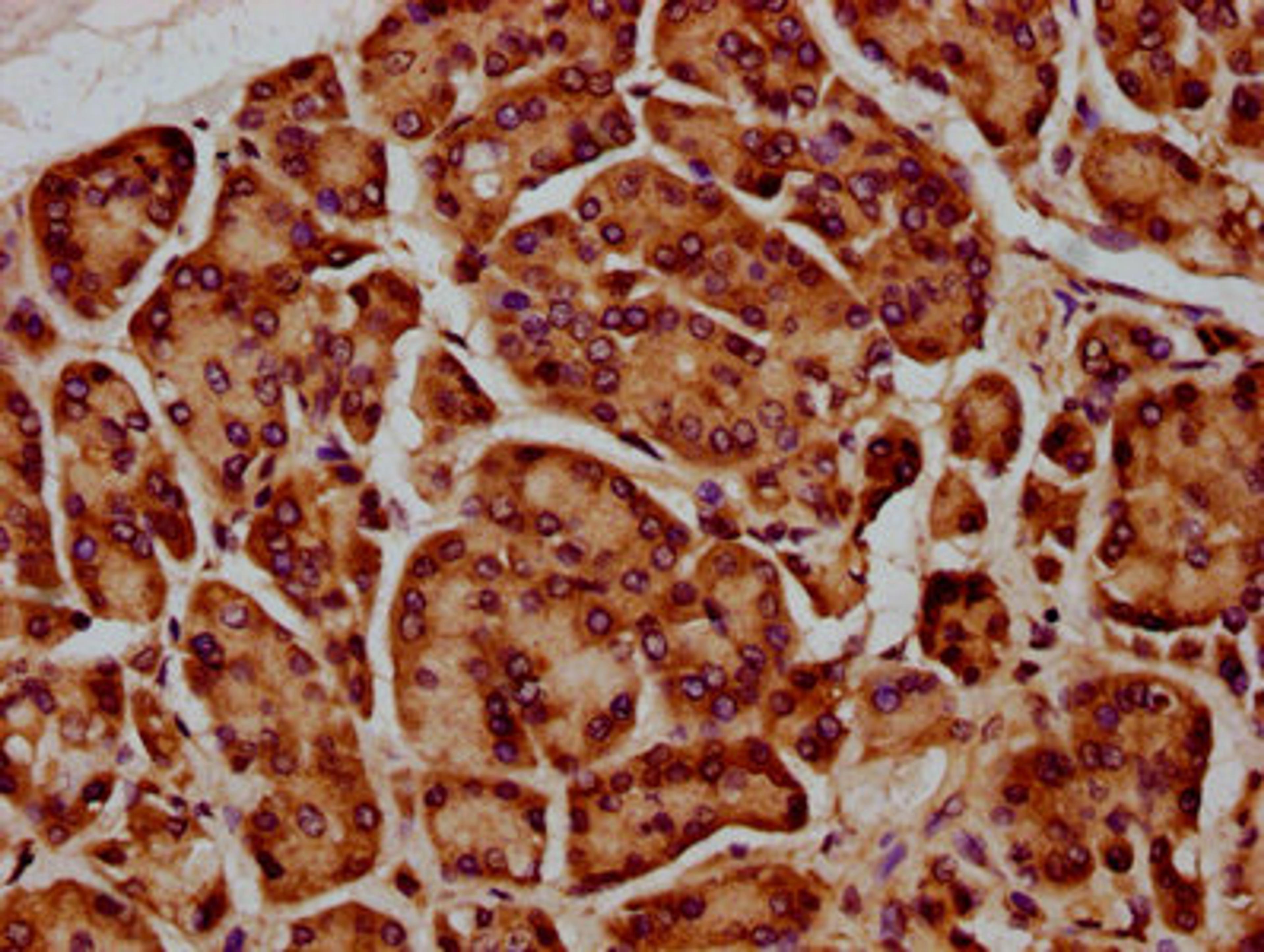 IHC image of CSB-PA732939LA01HU diluted at 1:400 and staining in paraffin-embedded human pancreatic cancer performed on a Leica BondTM system. After dewaxing and hydration, antigen retrieval was mediated by high pressure in a citrate buffer (pH 6.0). Section was blocked with 10% normal goat serum 30min at RT. Then primary antibody (1% BSA) was incubated at 4&deg;C overnight. The primary is detected by a biotinylated secondary antibody and visualized using an HRP conjugated SP system.