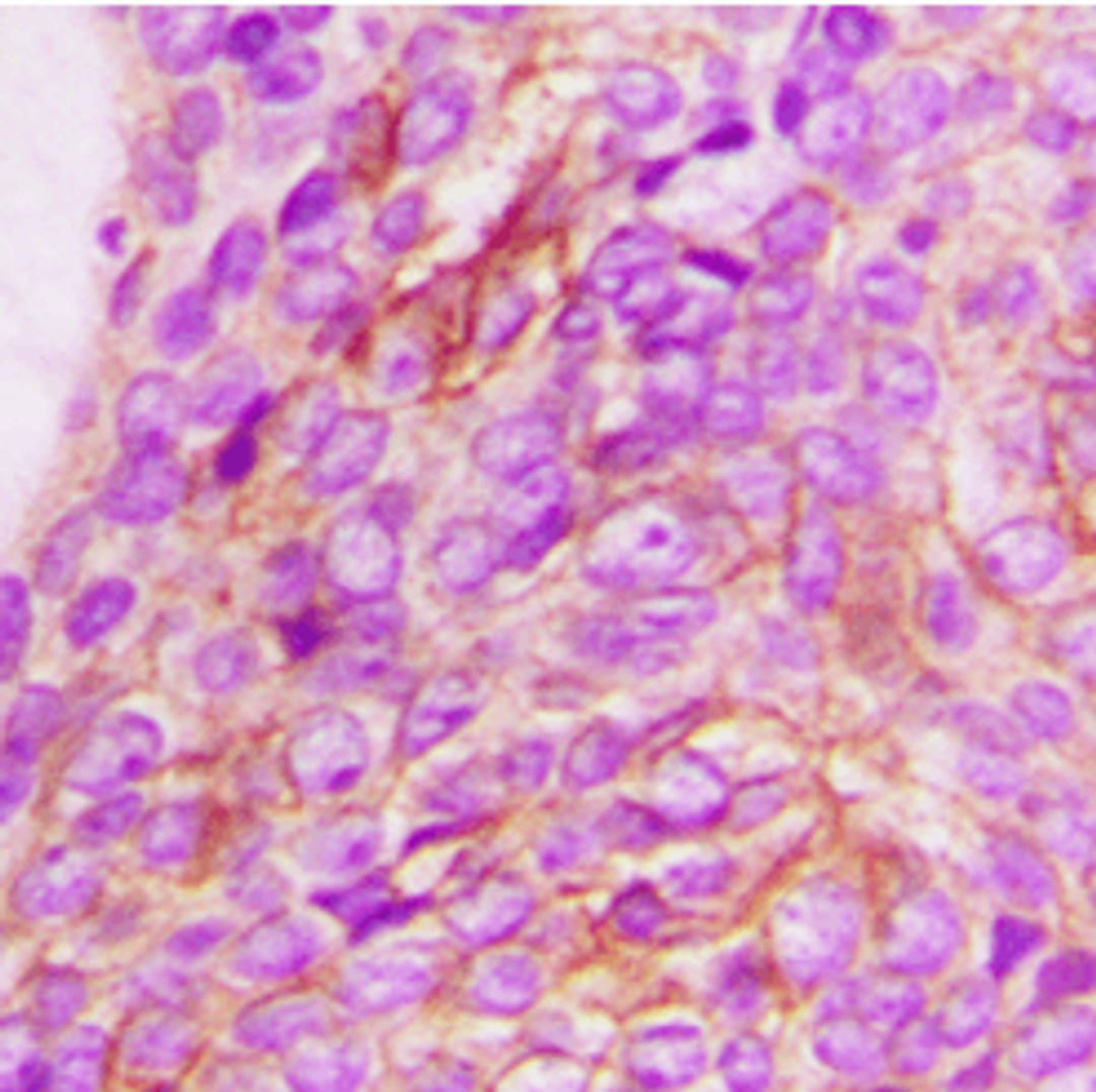 Immunohistochemical staining of human breast cancer using IL13RA1 antibody