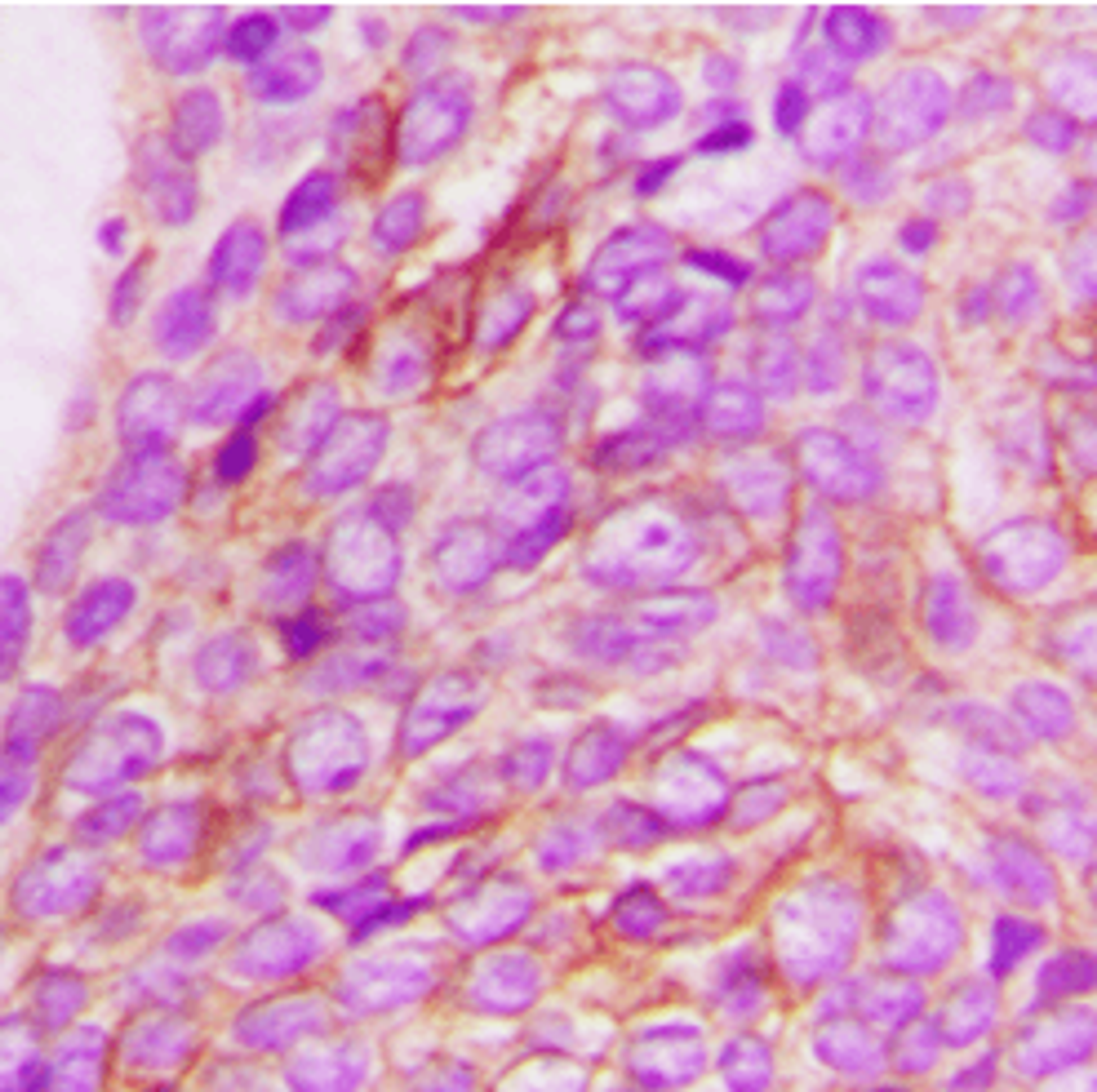 Immunohistochemical staining of human breast cancer using IL13RA1 antibody