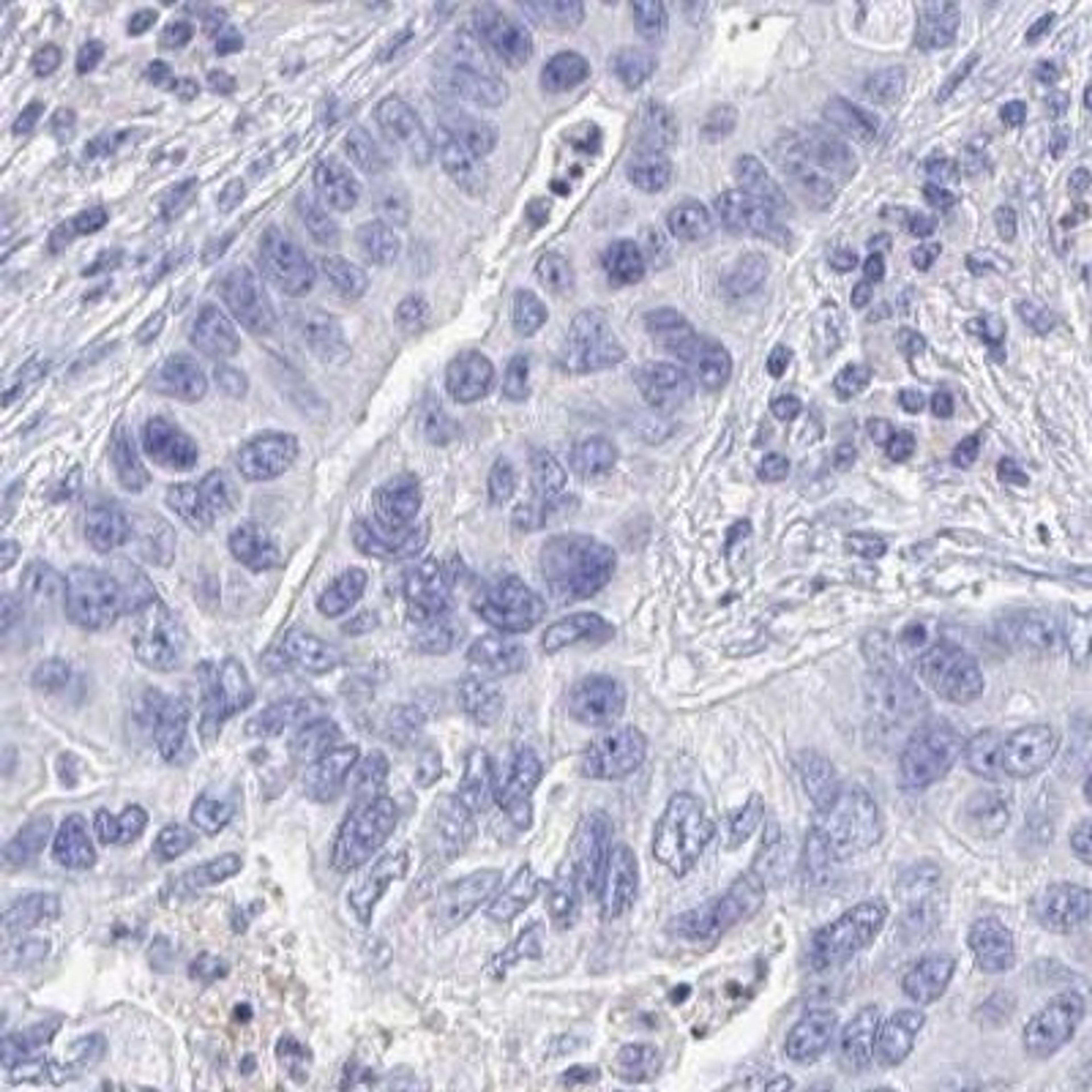 Immunohistochemistry: KRT82 Antibody [NBP2-31727] - lung cancer