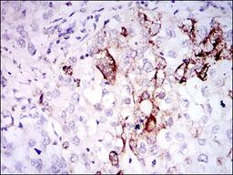 Immunohistochemistry: Somatostatin Antibody (7G5) [NBP2-37447] - Immunohistochemical analysis of paraffin-embedded lung cancer tissues using SST mouse mAb with DAB staining.