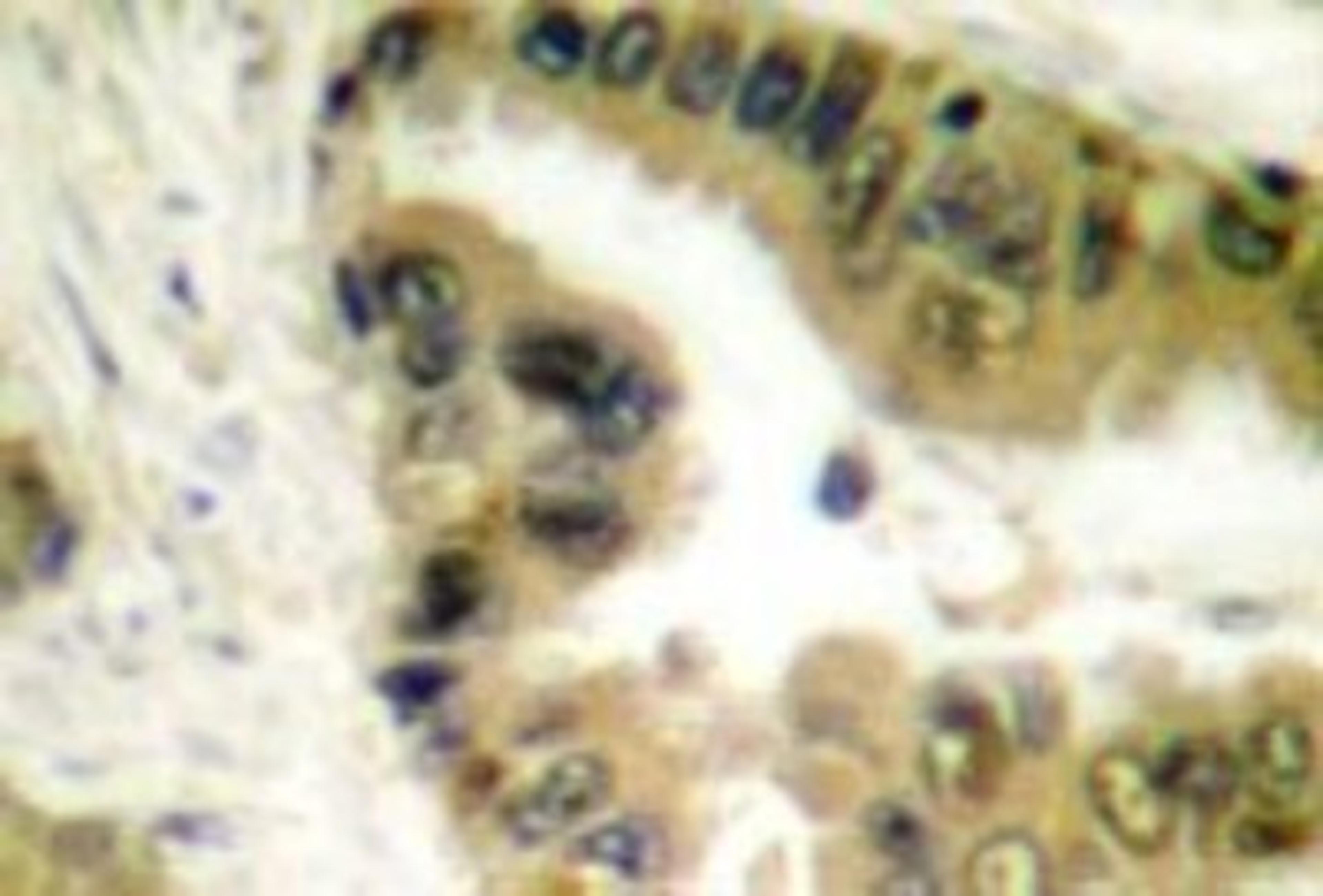 Immunohistochemistry-Paraffin: HDAC10 Antibody [NB100-91801] - Human lung  carcinoma tissue