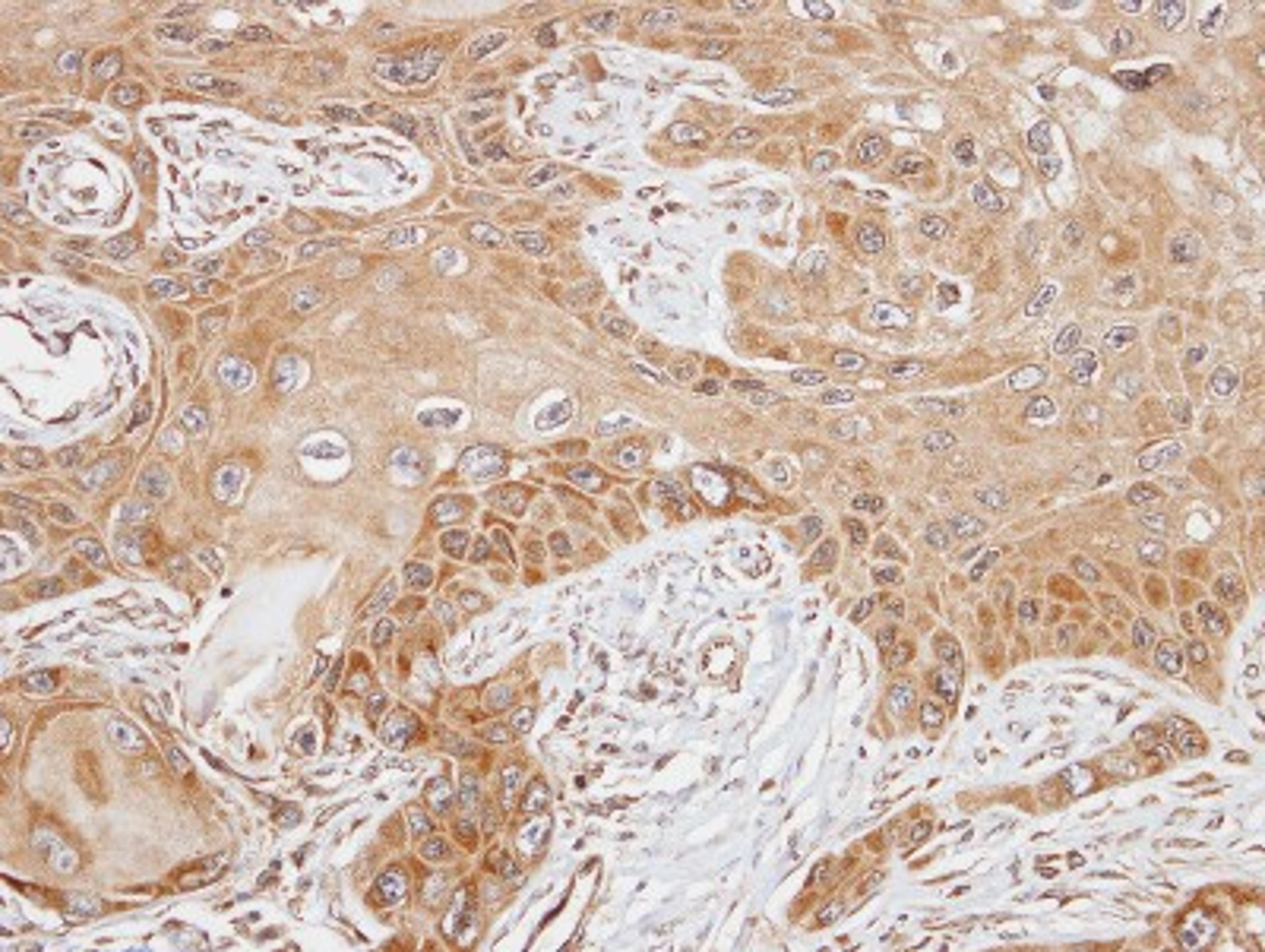 Immunohistochemistry-Paraffin: FASTK Antibody [NBP1-31323] - Paraffin-embedded SCC15 xenograft, using antibody at 1:100 dilution.