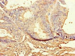Immunohistochemistry of paraffin-embedded human endometrial cancer using CSB-PA002883LA01HU at dilution of 1:100