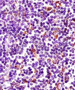 IHC-P of  human pancreatic cancer  tissue (MHC Class II antibody at 1:200)