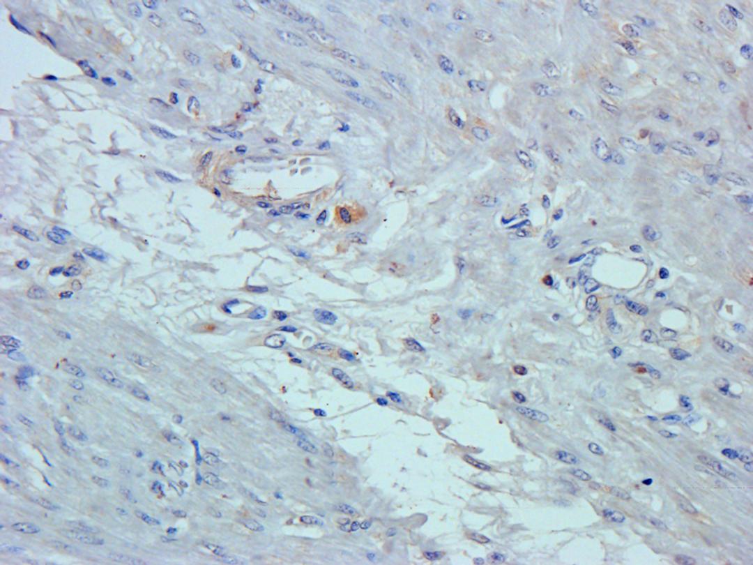 IHC-P staining of human endometrial cancer tissue using anti-GPR109A (2.5 ug/ml)