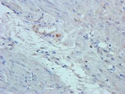 IHC-P staining of human endometrial cancer tissue using anti-GPR109A (2.5 ug/ml)