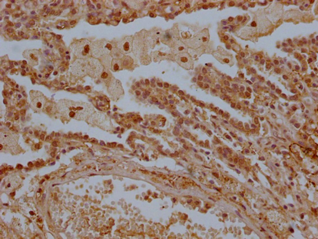 IHC image of CSB-PA013228OA01HU diluted at 1:300 and staining in paraffin-embedded human lung tissue performed on a Leica BondTM system. After dewaxing and hydration, antigen retrieval was mediated by high pressure in a citrate buffer (pH 6.0). Section was blocked with 10% normal goat serum 30min at RT. Then primary antibody (1% BSA) was incubated at 4°C overnight. The primary is detected by a Goat anti-rabbit polymer IgG labeled by HRP and visualized using 0.05% DAB.