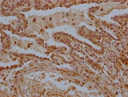 IHC image of CSB-PA013228OA01HU diluted at 1:300 and staining in paraffin-embedded human lung tissue performed on a Leica BondTM system. After dewaxing and hydration, antigen retrieval was mediated by high pressure in a citrate buffer (pH 6.0). Section was blocked with 10% normal goat serum 30min at RT. Then primary antibody (1% BSA) was incubated at 4°C overnight. The primary is detected by a Goat anti-rabbit polymer IgG labeled by HRP and visualized using 0.05% DAB.