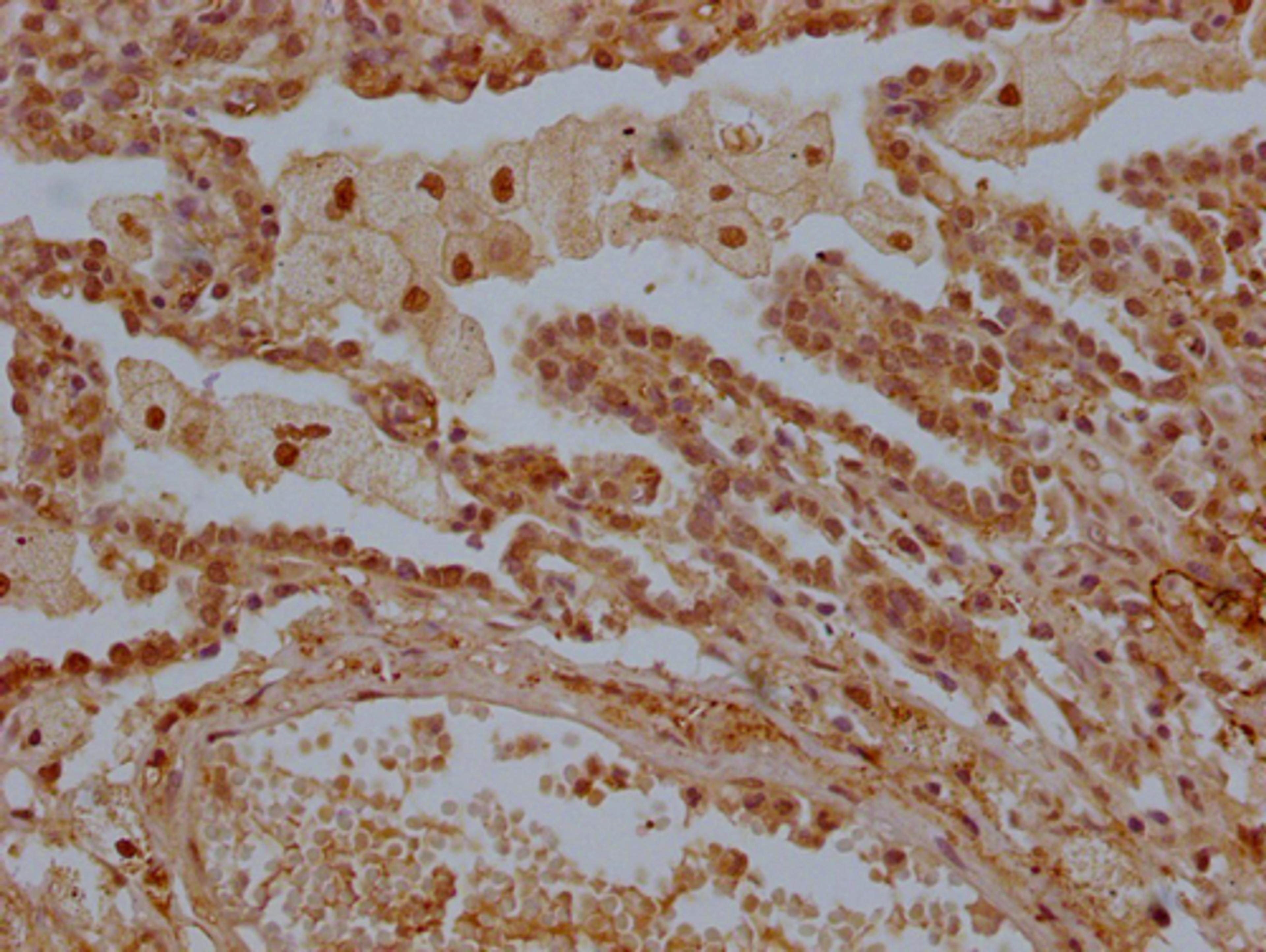 IHC image of CSB-PA013228OA01HU diluted at 1:300 and staining in paraffin-embedded human lung tissue performed on a Leica BondTM system. After dewaxing and hydration, antigen retrieval was mediated by high pressure in a citrate buffer (pH 6.0). Section was blocked with 10% normal goat serum 30min at RT. Then primary antibody (1% BSA) was incubated at 4°C overnight. The primary is detected by a Goat anti-rabbit polymer IgG labeled by HRP and visualized using 0.05% DAB.