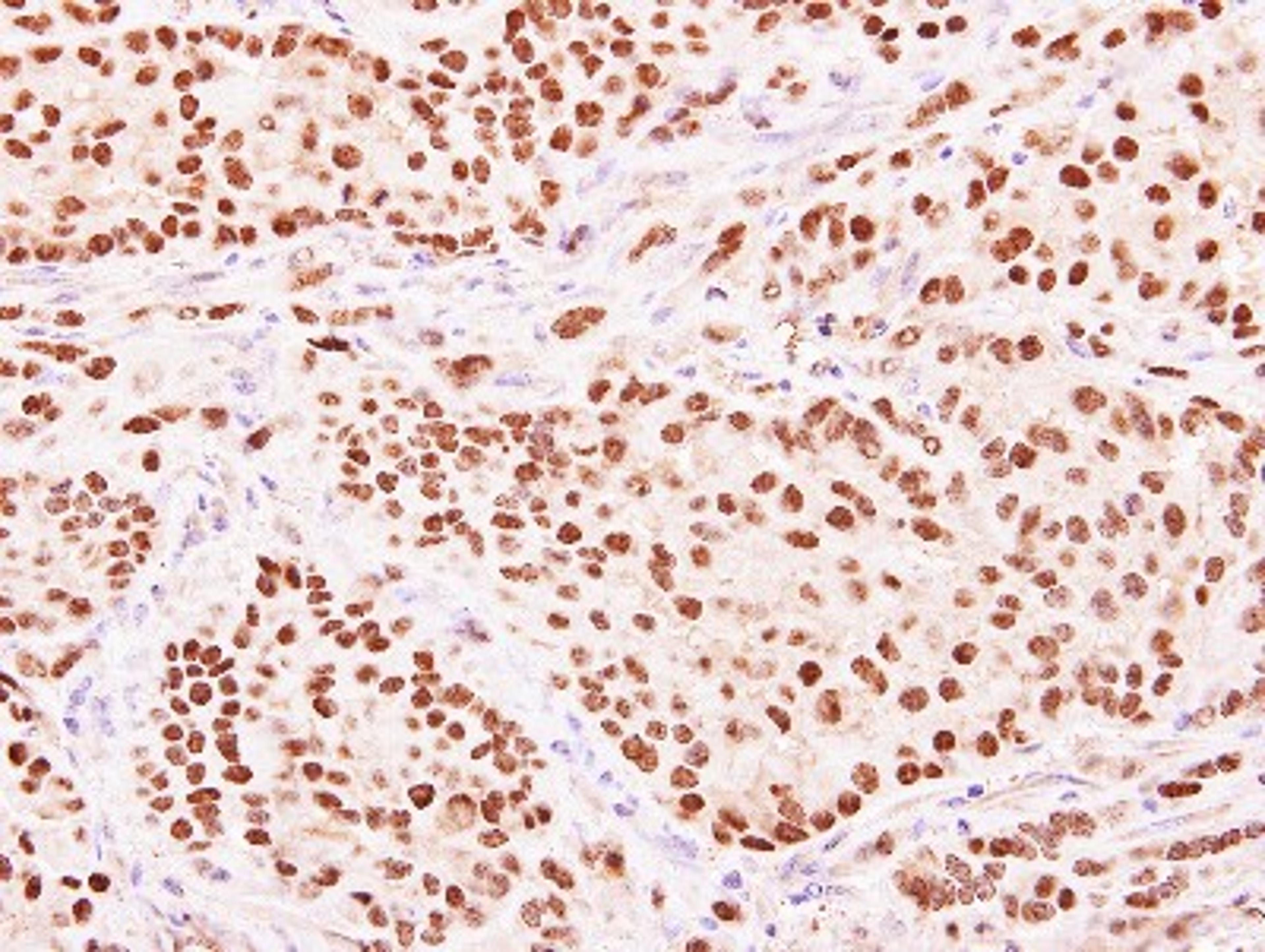 Immunohistochemistry-Paraffin: HENMT1 Antibody [NBP1-32620] - Paraffin-embedded A549 xenograft, using antibody at 1:500 dilution.