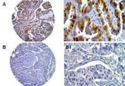 Immunohistochemistry-Paraffin: Caspase 14 Antibody [NB100-56126] - Formalin-fixed paraffin-embedded sections from a human ovarian cancer tissue microarray stained for Caspase-14 expression using this antibody at 1:2000. Low (A) and high (B) stage ovarian tumor tissue cores. High magnification from areas of the tissue cores (A1 and B1). Decreased Caspase-14 expression was seen in the high grade, compared to the low grade tumor. Hematoxylin-eosin counterstain.