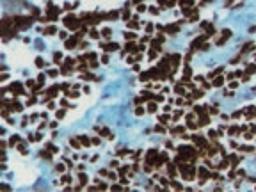 Immunohistochemistry: Myogenin Antibody (5FD) [NB100-56510] - Immunohistochemical analysis of Myogenin in a frozen tissue section of human alveolar rhabdomyosarcoma using NB100-56510 at 5 ug/ml.