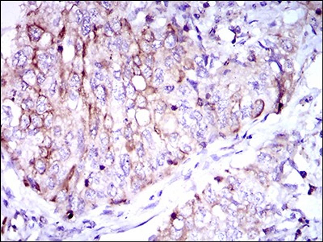 Immunohistochemistry: CD7 Antibody (4D4F8) [NBP2-37367] - Immunohistochemical analysis of paraffin-embedded lung cancer tissues using CD7 mouse mAb with DAB staining.