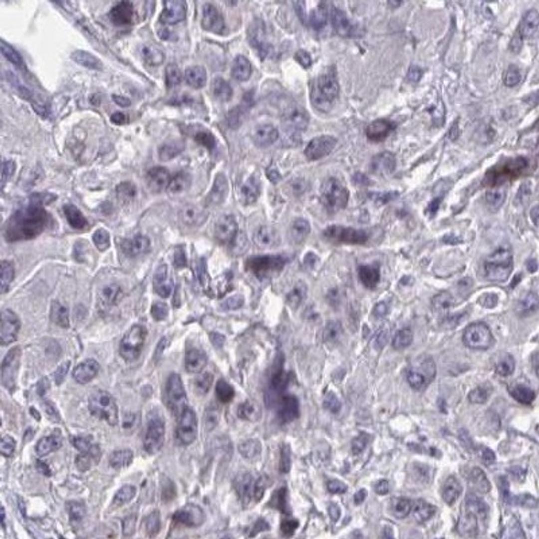 Immunohistochemistry: NUP133 Antibody [NBP2-31795] - liver cancer