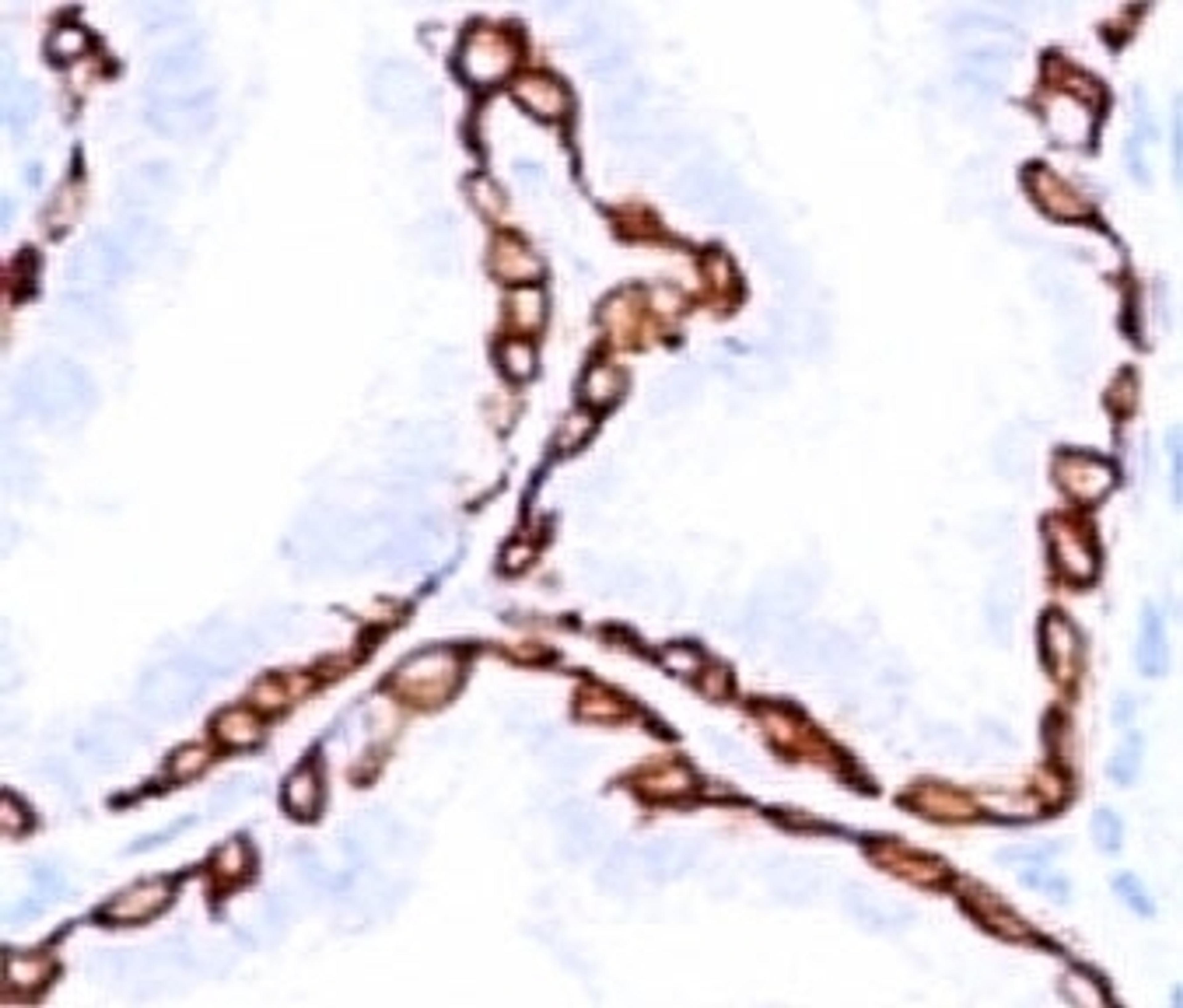 Formalin-fixed, paraffin-embedded human prostate carcinoma stained with anti-Cytokeratin 14 antibody (SPM263).