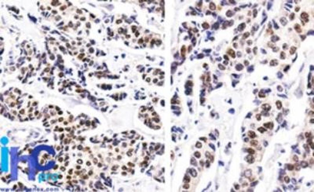 Flow Cytometry: Estrogen Receptor Antibody (ER506) [NBP2-33320] - Analysis using the PE conjugate of NBP2-33320. Staining of human breast invasive ductal carcinoma stained with Estrogen Receptor MAb (ER506).