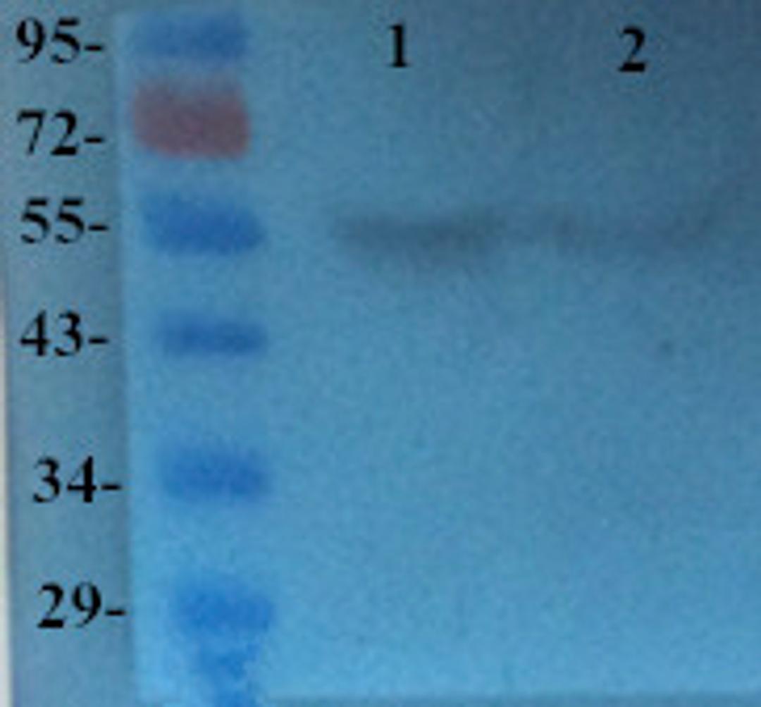 Western blot analysis of Human breast cancer 1 (Lane 1), Human breast cancer 2 (Lane 2) using TGF beta Receptor 2 (dilution of primary antibody - 2 ug/ml)