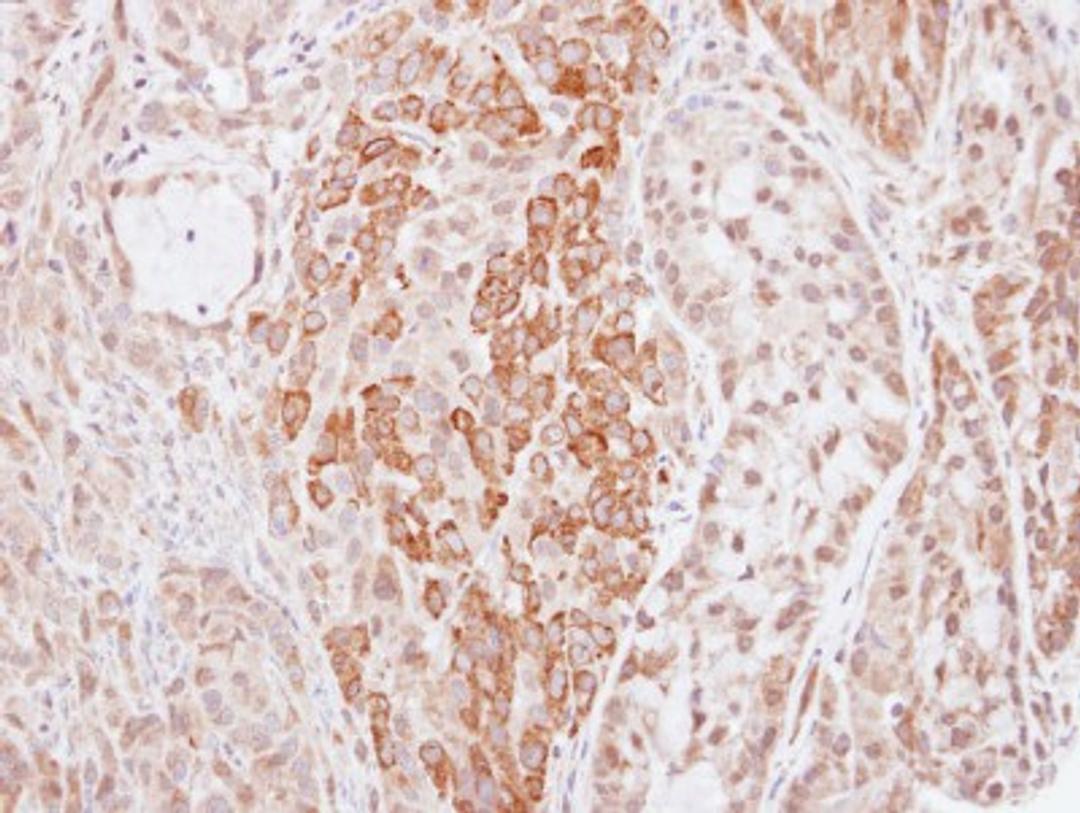 Immunohistochemistry-Paraffin: HMW Kininogen Antibody [NBP1-31340] - Paraffin-embedded A549 xenograft, using antibody at 1:500 dilution.