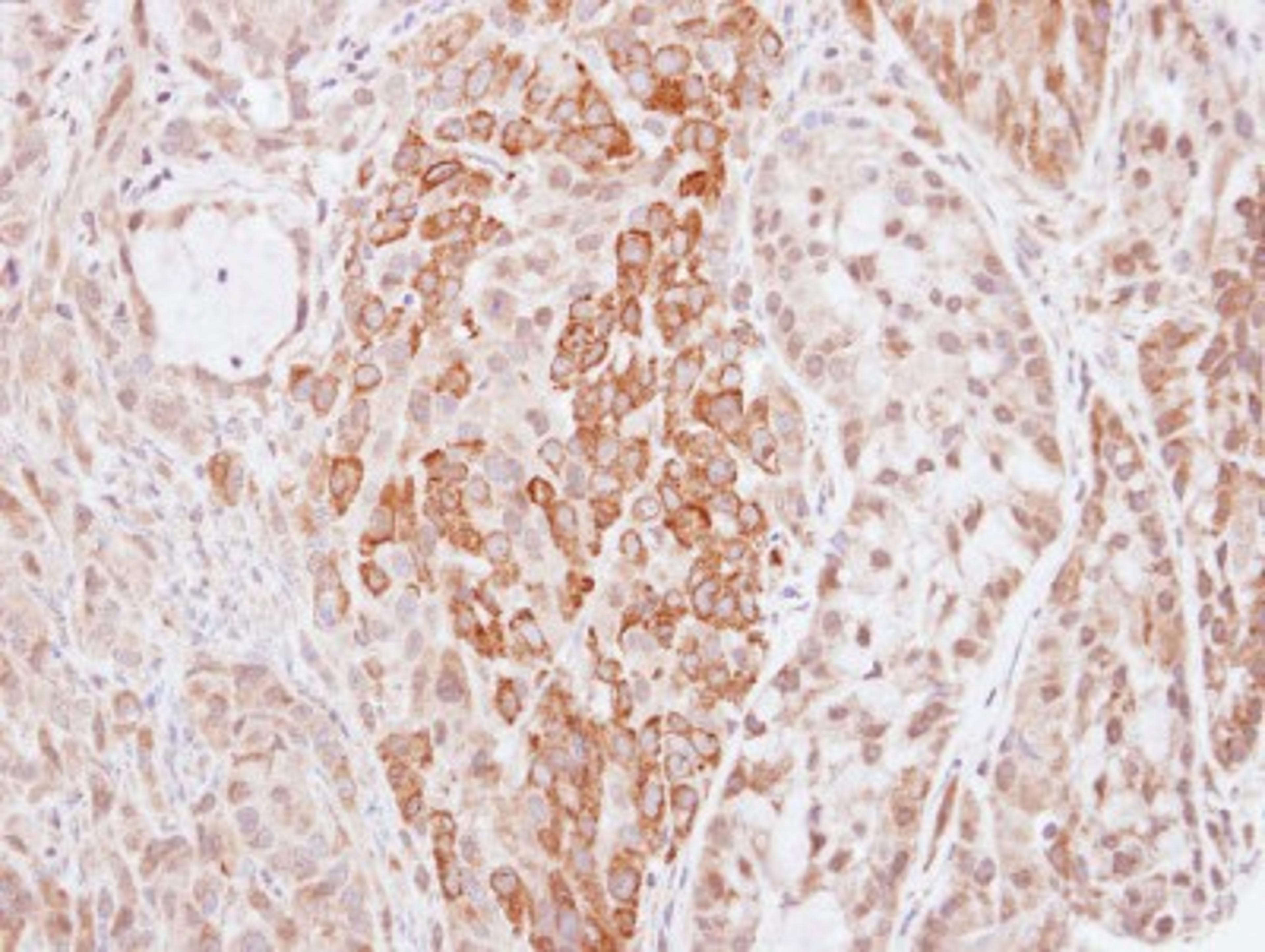 Immunohistochemistry-Paraffin: HMW Kininogen Antibody [NBP1-31340] - Paraffin-embedded A549 xenograft, using antibody at 1:500 dilution.