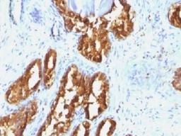 IHC testing of human prostate carcinoma with PSAP antibody (clone ACCP/1338). Required HIER: boil tissue sections in 10mM citrate buffer, pH 6, for 10-20 min followed by cooling at RT for 20 min.