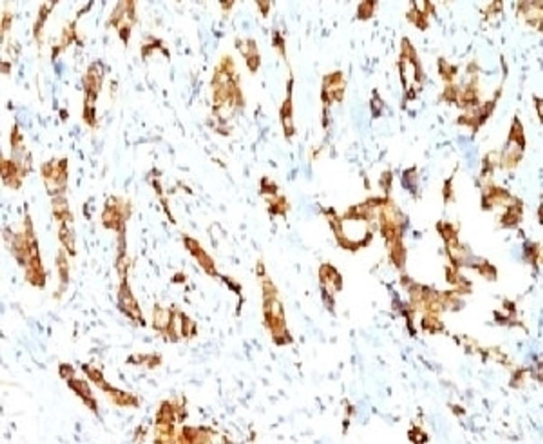 Formalin-fixed, paraffin-embedded human breast carcinoma stained with HSP27 antibody (SPM252)