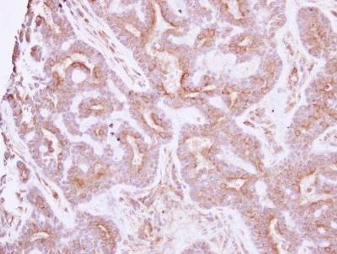 Immunohistochemistry-Paraffin: NELL1 Antibody [NBP2-19511] - Immunohistochemical analysis of paraffin-embedded Breast ca, using antibody at 1:250 dilution.