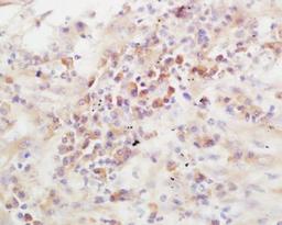 Immunohistochemical staining of human lung carcinoma tissue using ADAMTS13 antibody.