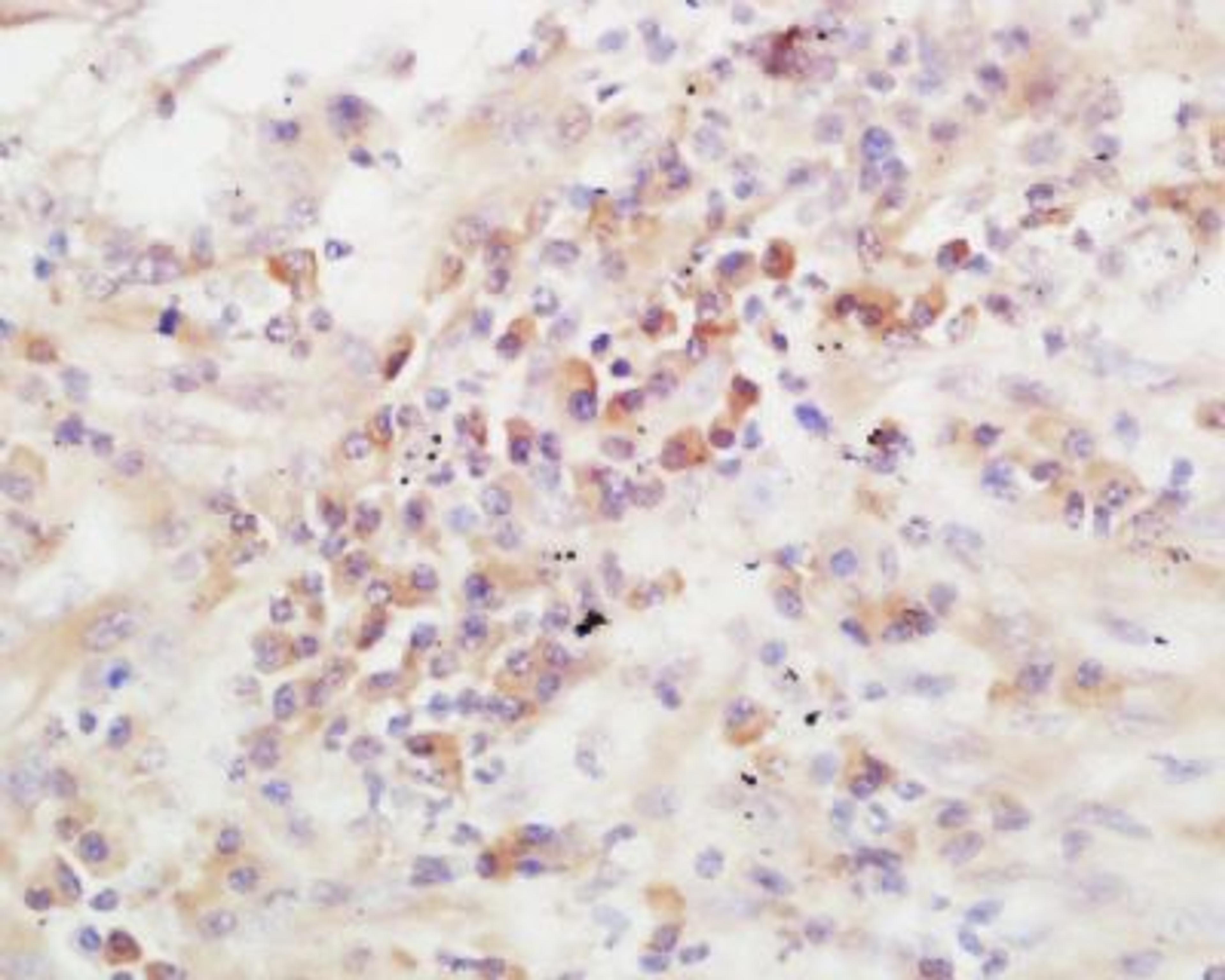 Immunohistochemical staining of human lung carcinoma tissue using ADAMTS13 antibody.