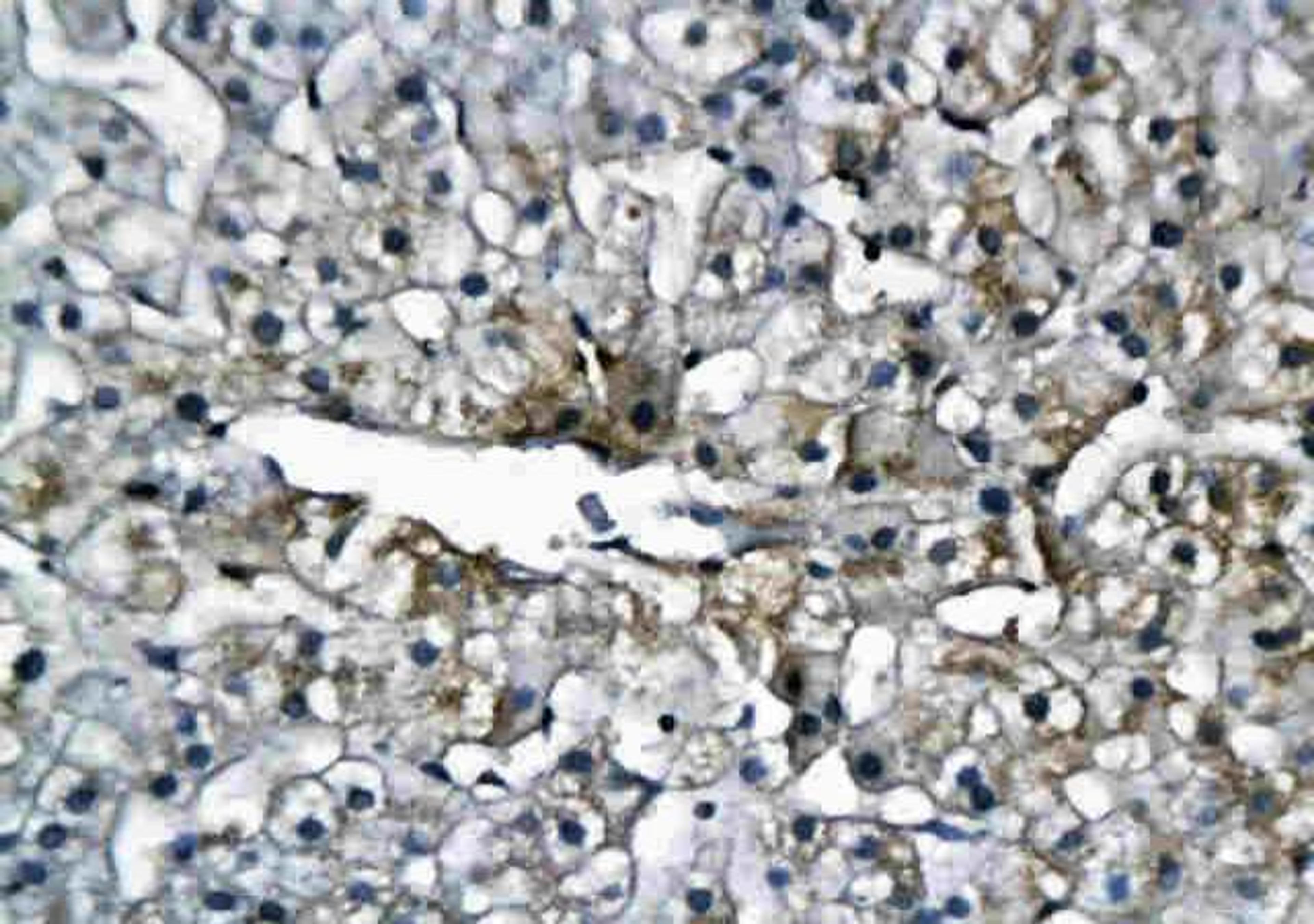 IHC-P of human hepatitis using IFNAR2 antibody.