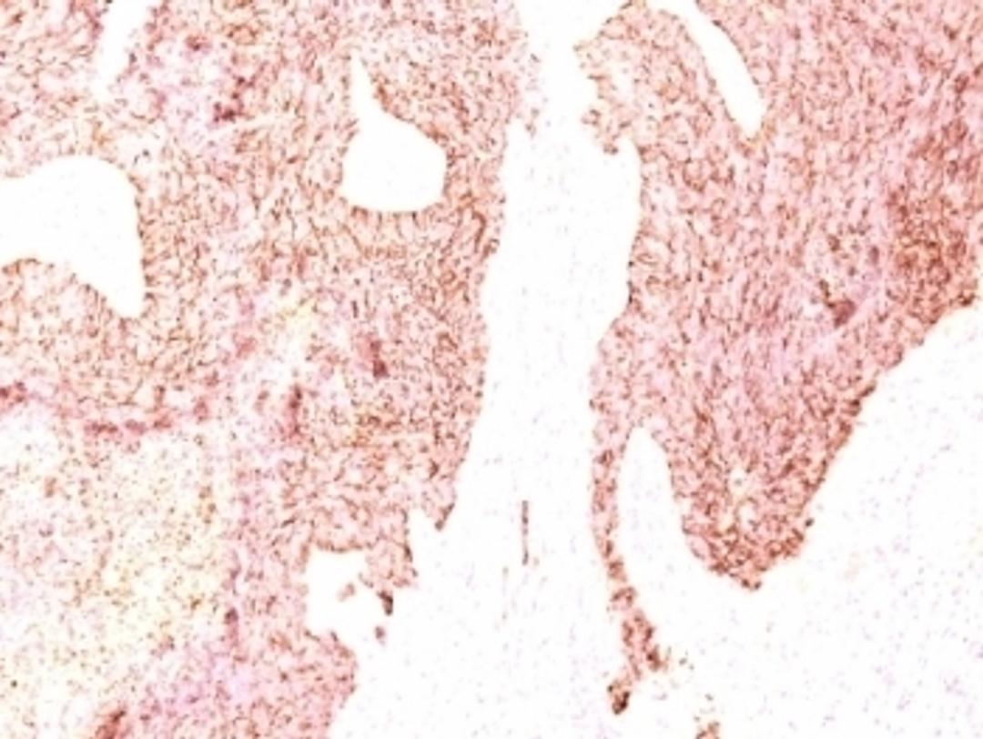 Formalin-fixed, paraffin-embedded human small cell lung carcinoma stained with Chromogranin A antibody (SPM339)