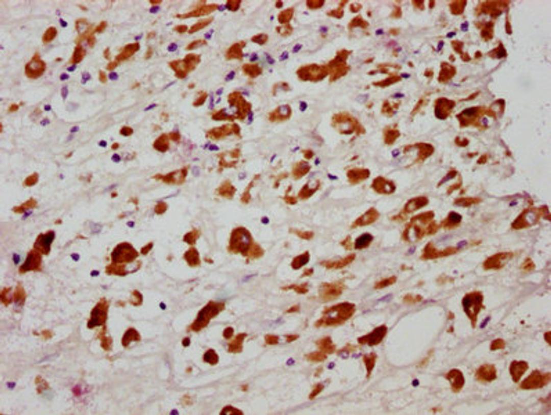 IHC image of CSB-RA850851A358phHU diluted at 1:100 and staining in paraffin-embedded human melanoma cancer performed on a Leica BondTM system. After dewaxing and hydration, antigen retrieval was mediated by high pressure in a citrate buffer (pH 6.0). Section was blocked with 10% normal goat serum 30min at RT. Then primary antibody (1% BSA) was incubated at 4℃ overnight. The primary is detected by a biotinylated secondary antibody and visualized using an HRP conjugated SP system.