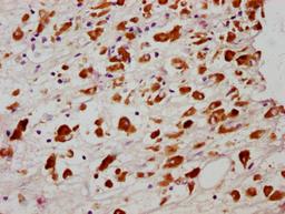 IHC image of CSB-RA850851A358phHU diluted at 1:100 and staining in paraffin-embedded human melanoma cancer performed on a Leica BondTM system. After dewaxing and hydration, antigen retrieval was mediated by high pressure in a citrate buffer (pH 6.0). Section was blocked with 10% normal goat serum 30min at RT. Then primary antibody (1% BSA) was incubated at 4℃ overnight. The primary is detected by a biotinylated secondary antibody and visualized using an HRP conjugated SP system.