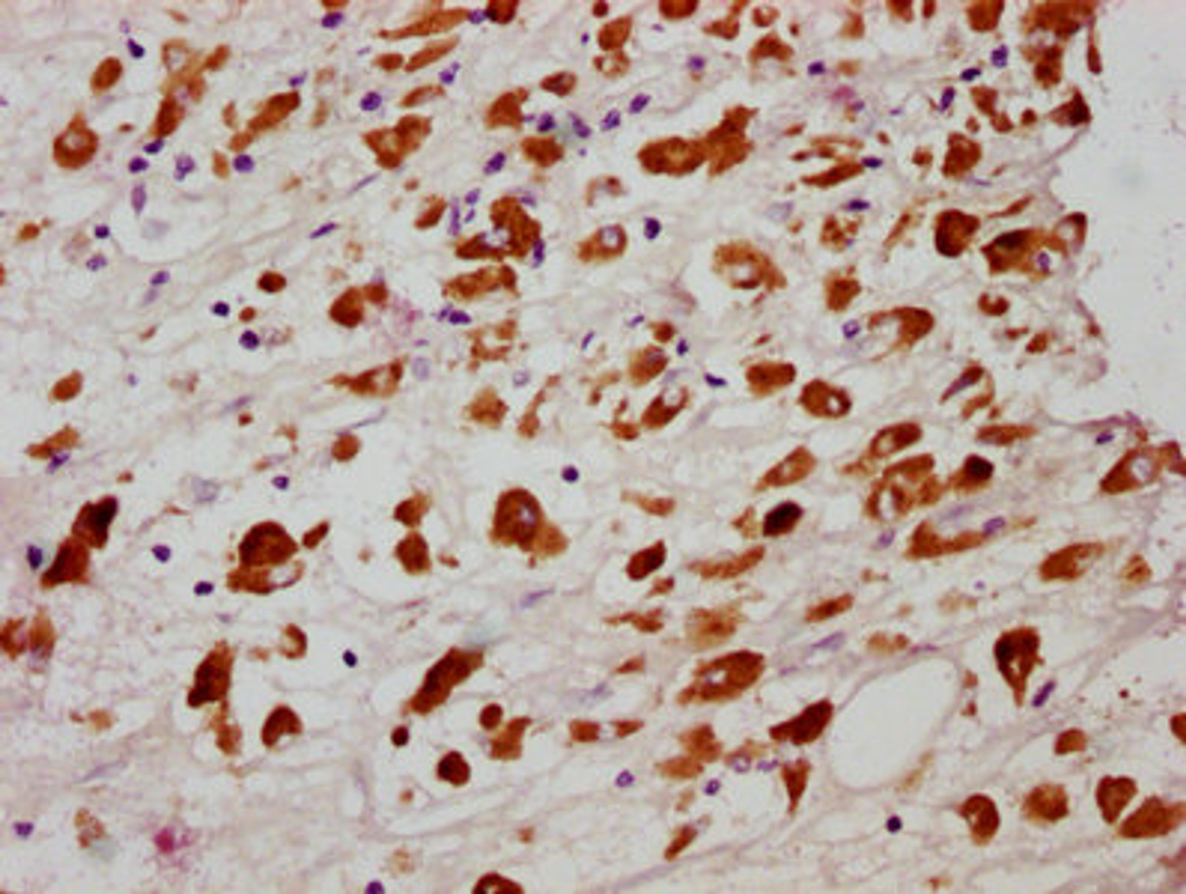 IHC image of CSB-RA850851A358phHU diluted at 1:100 and staining in paraffin-embedded human melanoma cancer performed on a Leica BondTM system. After dewaxing and hydration, antigen retrieval was mediated by high pressure in a citrate buffer (pH 6.0). Section was blocked with 10% normal goat serum 30min at RT. Then primary antibody (1% BSA) was incubated at 4℃ overnight. The primary is detected by a biotinylated secondary antibody and visualized using an HRP conjugated SP system.