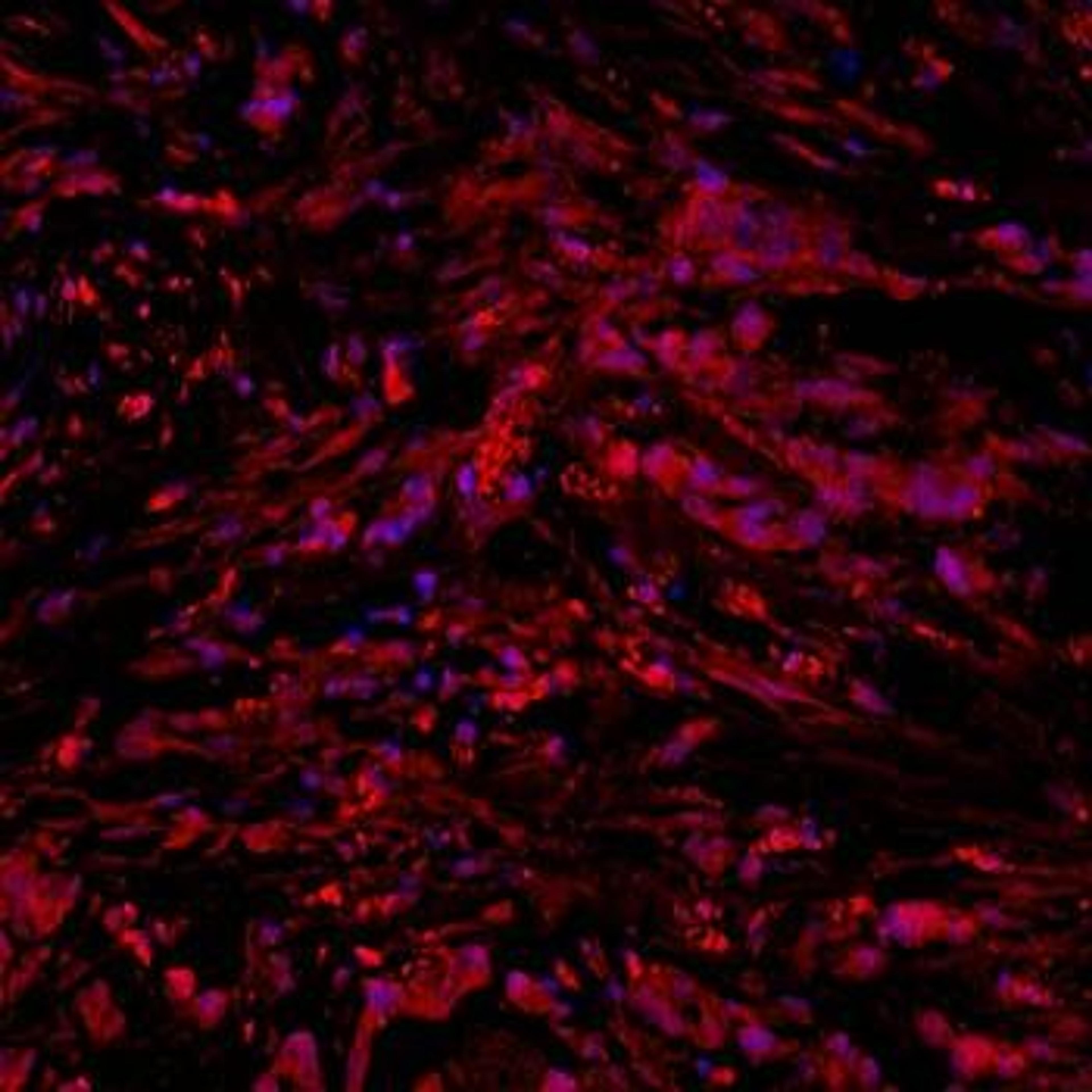 Immunohistochemical analysis of formalin-fixed and paraffin embedded human gastric cancer tissue (Dilution at:1:300) using UCP1 antibody