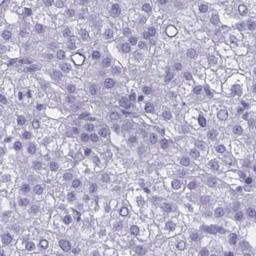 Immunohistochemistry: OR1L3 Antibody [NBP2-31731] - liver cancer