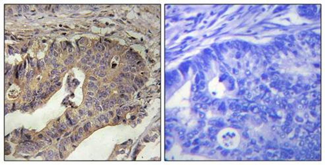 Immunohistochemical analysis of formalin-fixed and paraffin-embedded human breast carcinoma tissue using Fibrillin-1 antibody