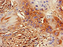 Immunohistochemistry of paraffin-embedded human cervical cancer using CSB-PA882074LA01HU at dilution of 1:100