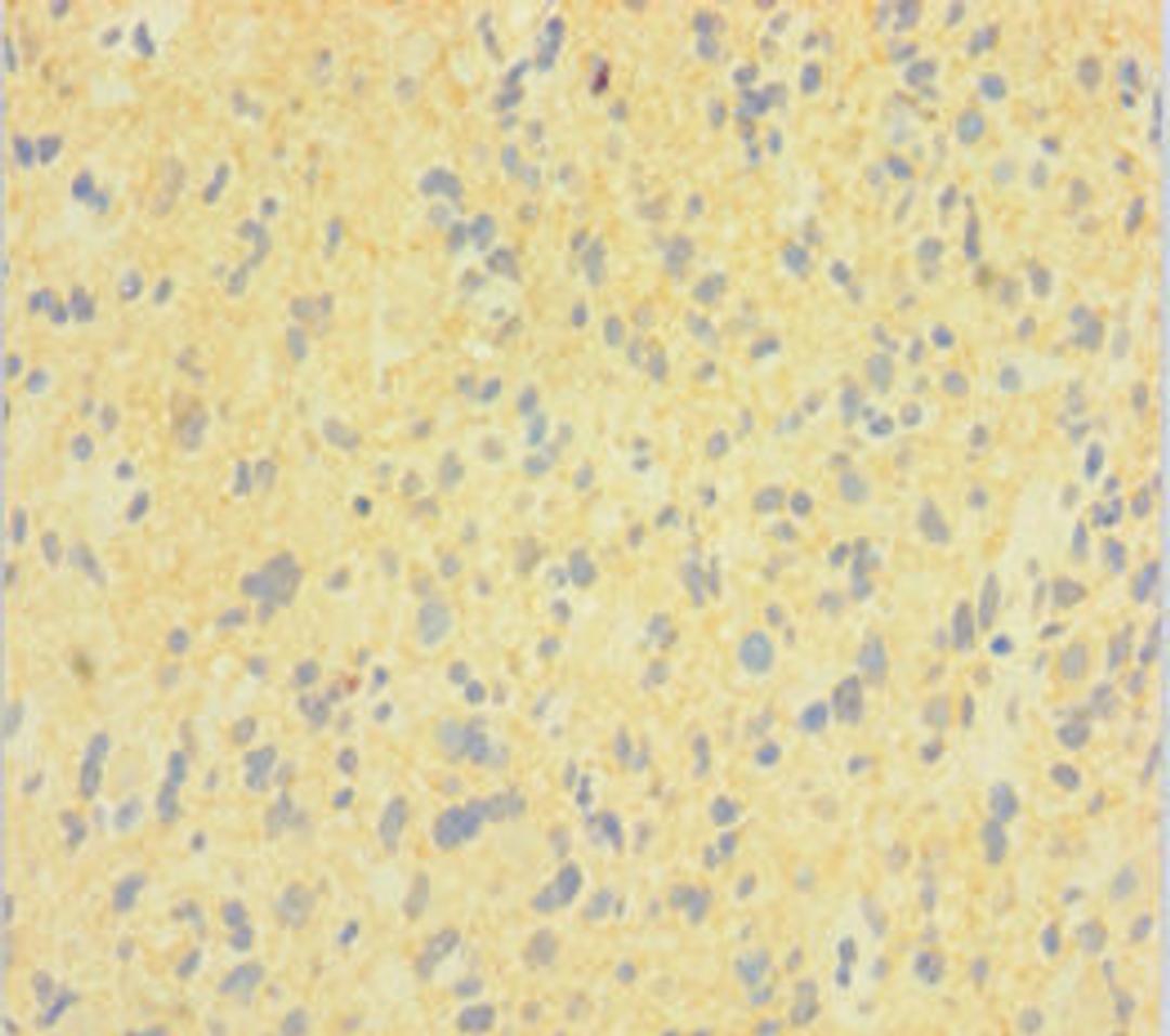 Immunohistochemistry of paraffin-embedded human glioma using CSB-PA007062LA01HU at dilution of 1:100
