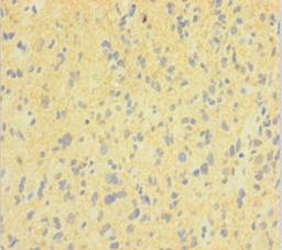 Immunohistochemistry of paraffin-embedded human glioma using CSB-PA007062LA01HU at dilution of 1:100