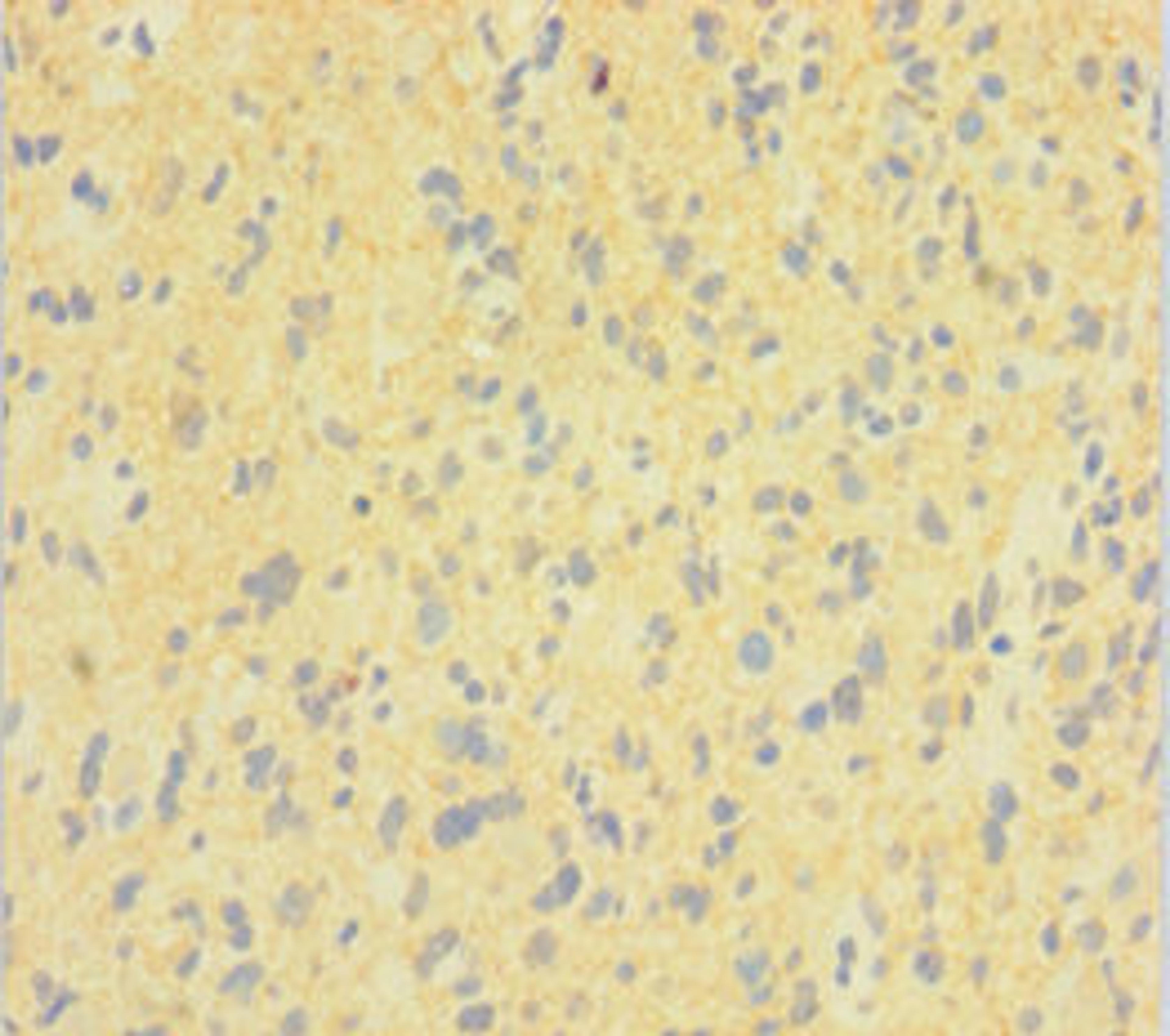 Immunohistochemistry of paraffin-embedded human glioma using CSB-PA007062LA01HU at dilution of 1:100