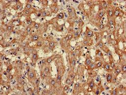 Immunohistochemistry of paraffin-embedded human liver cancer using CSB-PA005472LA01HU at dilution of 1:100