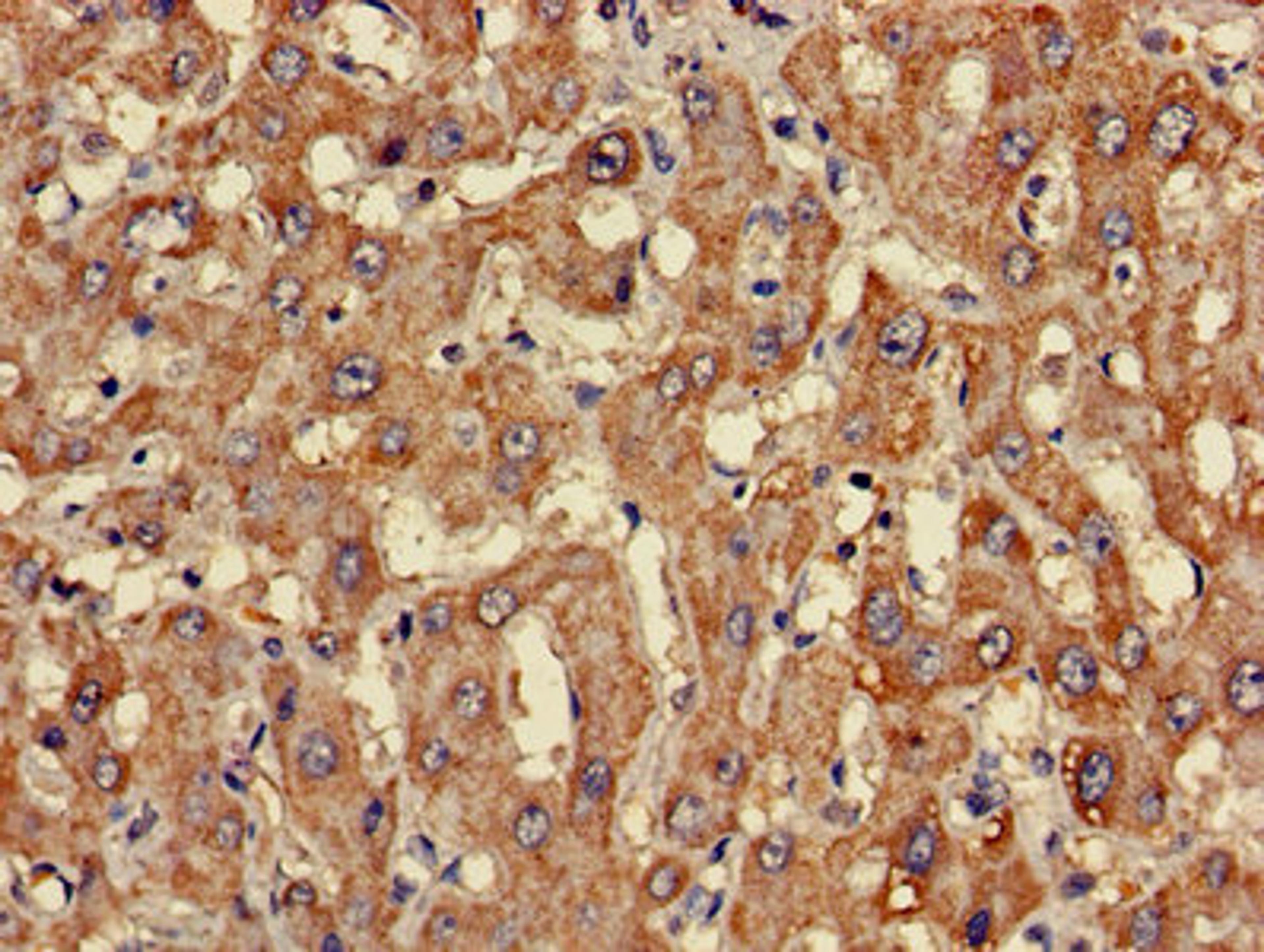 Immunohistochemistry of paraffin-embedded human liver cancer using CSB-PA005472LA01HU at dilution of 1:100