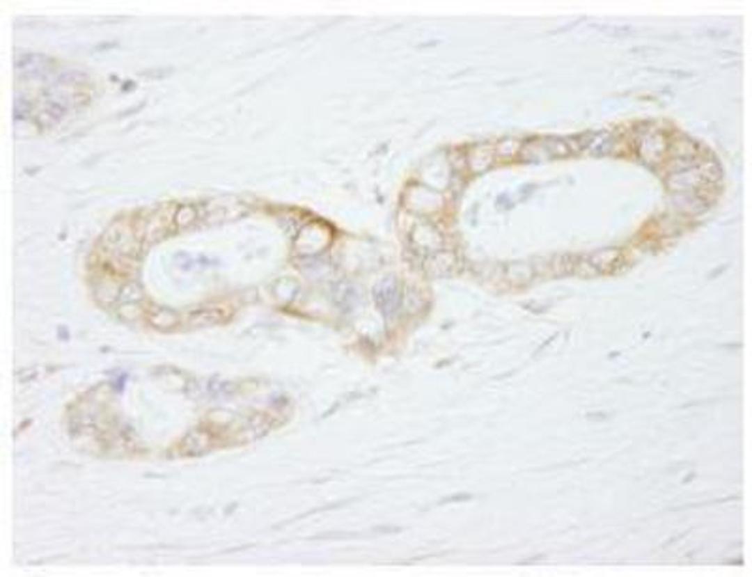 Immunohistochemistry-Paraffin: USP3 Antibody [NB100-77284] - FFPE section of human ovarian carcinoma.  Affinity purified rabbit anti-USP3 used at a dilution of 1:500. Detection: DAB staining using Immunohistochemistry Accessory Kit