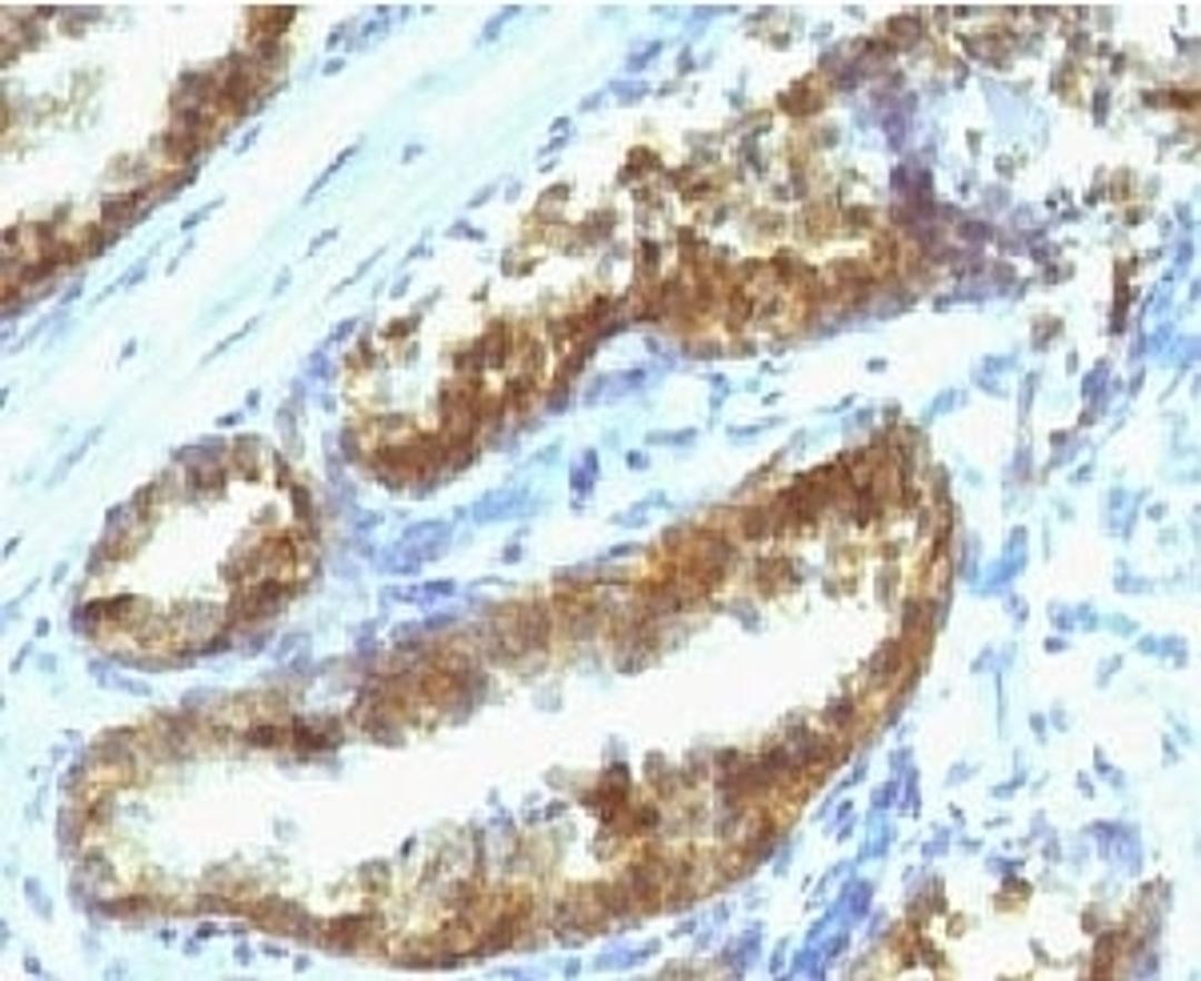 IHC testing of human prostate carcinoma with Prostate Specific antibody (PSAK3-1).