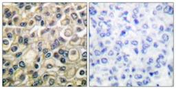 Immunohistochemistry-Paraffin: Claudin 1 Antibody [NBP1-67515] - Analysis of paraffin-embedded human breast carcinoma tissue, using Claudin 1 Antibody. The picture on the right is treated with the synthesized peptide.